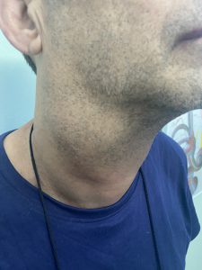 Πλαγιοτραχηλική λεμφαδενική διόγκωση ( μετάσταση από καρκίνο στοματοφάρυγγα)