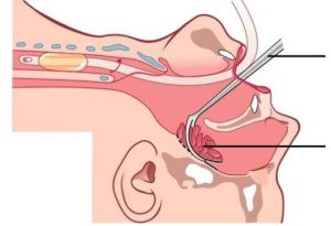 Αδενοτομή με τη χρήση ειδικού εργαλείου (curette) μέσα από το στόμα