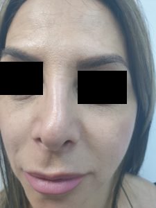 οξή μύτη με σχήμα σαν ‘ανάστροφο C’