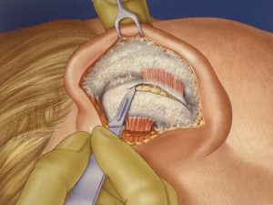 Τεχνική διαμόρφωσης χόνδρου (cartilage scoring)