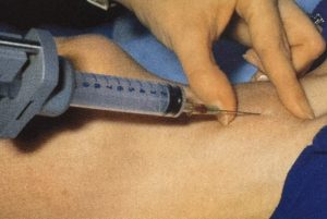 Βιοψία με λεπτή βελόνα (FNA) τραχηλικής μάζας