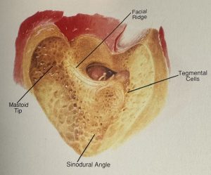 Μαστοειδεκτομή με αφαίρεση του οπίσθιου τοιχώματος του πόρου έως το επίπεδο του προσωπικού καναλιού ( canal wall down επέμβαση)
